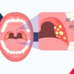 Tonsil Stones Treatments
