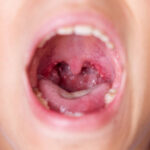 Tonsil Stones Treatments