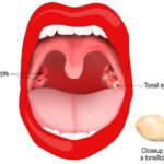 How Tonsil Stones Treatments Assist Frequent Sufferers