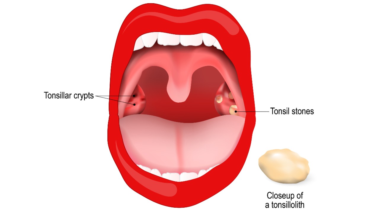How Tonsil Stones Treatments Assist Frequent Sufferers