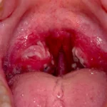Can Tonsil Stones Treatments Work Without Medication