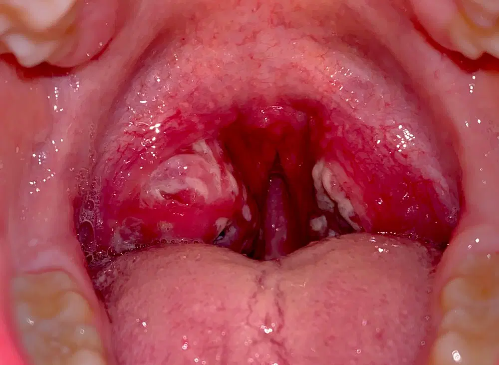 Can Tonsil Stones Treatments Work Without Medication