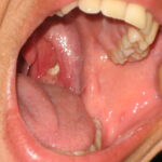 Why Tonsil Stones Treatments Help Chronic Conditions