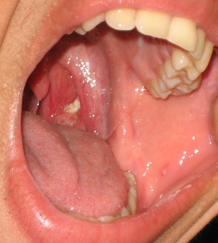 Why Tonsil Stones Treatments Help Chronic Conditions