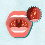 What Tonsil Stones Treatments Offer For Teenagers