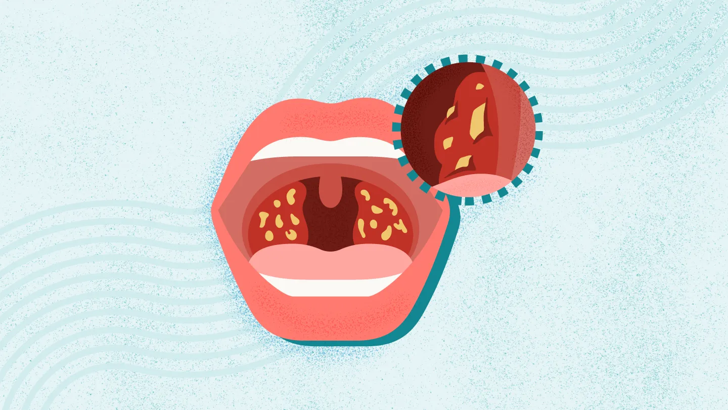 What Tonsil Stones Treatments Offer For Teenagers