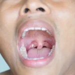 How Tonsil Stones Treatments Improve Swallowing Comfort