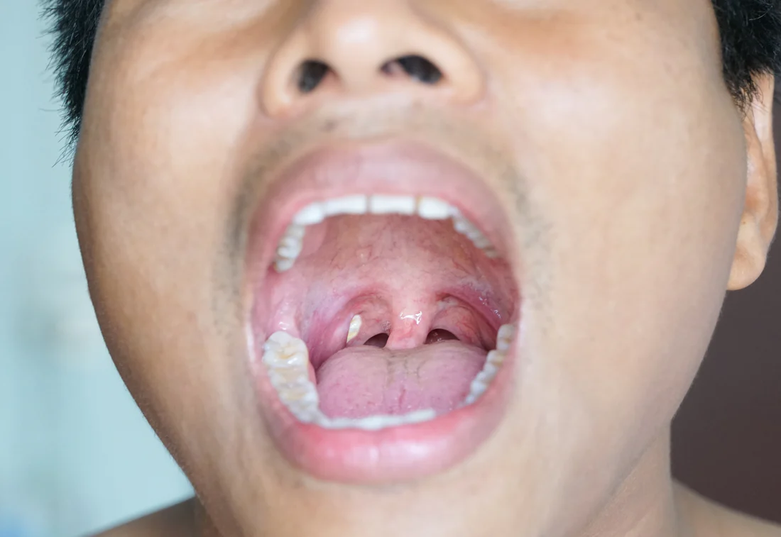 How Tonsil Stones Treatments Improve Swallowing Comfort