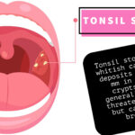 When Tonsil Stones Treatments Need Professional Support