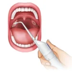 Should Tonsil Stones Treatments Include Water Flossing