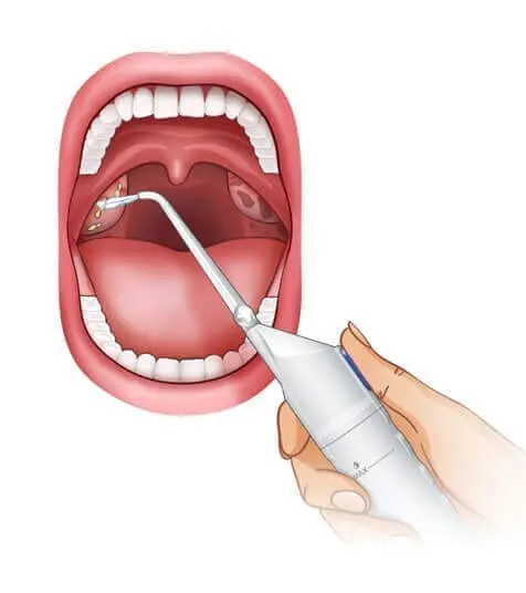 Should Tonsil Stones Treatments Include Water Flossing