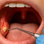 What Tonsil Stones Treatments Mean For Daily Comfort