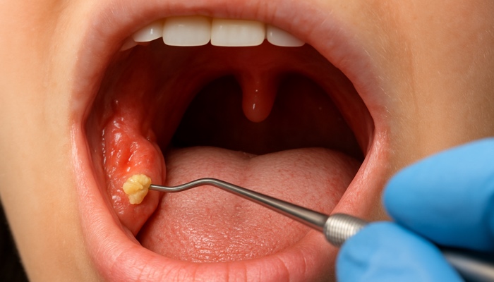 What Tonsil Stones Treatments Mean For Daily Comfort