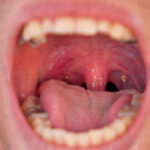 Do Tonsil Stones Treatments Ease Throat Irritation