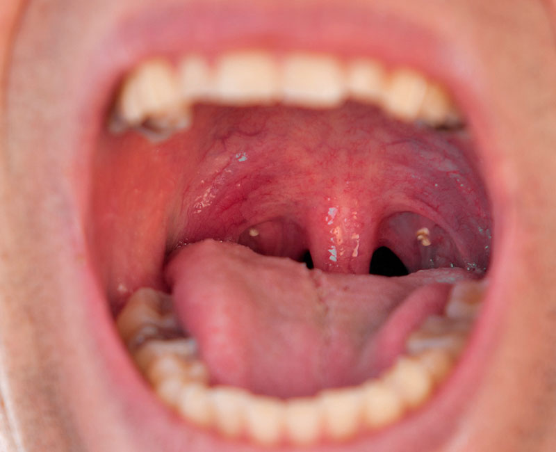 Do Tonsil Stones Treatments Ease Throat Irritation