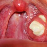 When Tonsil Stones Treatments Should Be Applied