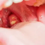 How Tonsil Stones Treatments Reduce Bad Breath