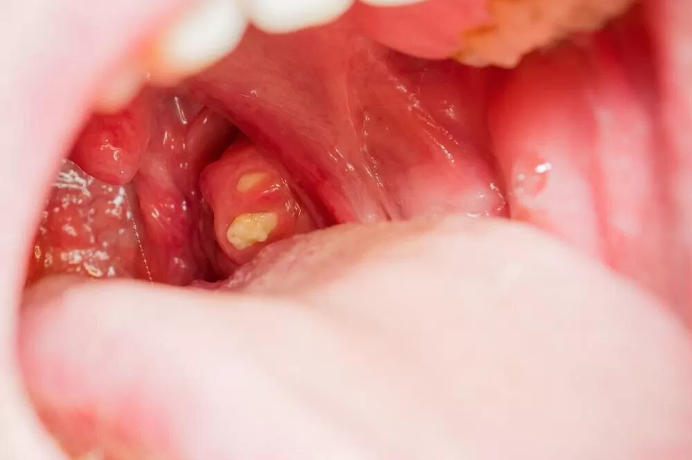 How Tonsil Stones Treatments Reduce Bad Breath